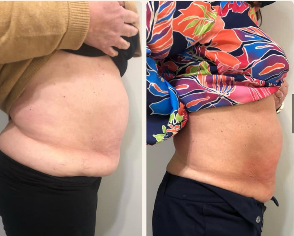Cryoskin Slim