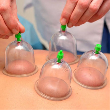 Cupping Massage at Sole Sisters Reflexology and Spa in Clyde or Abilene, TX