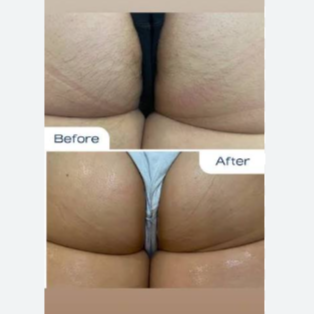Brazilian Laser Hair Removal at The Beautee Spot in Phoenix, AZ