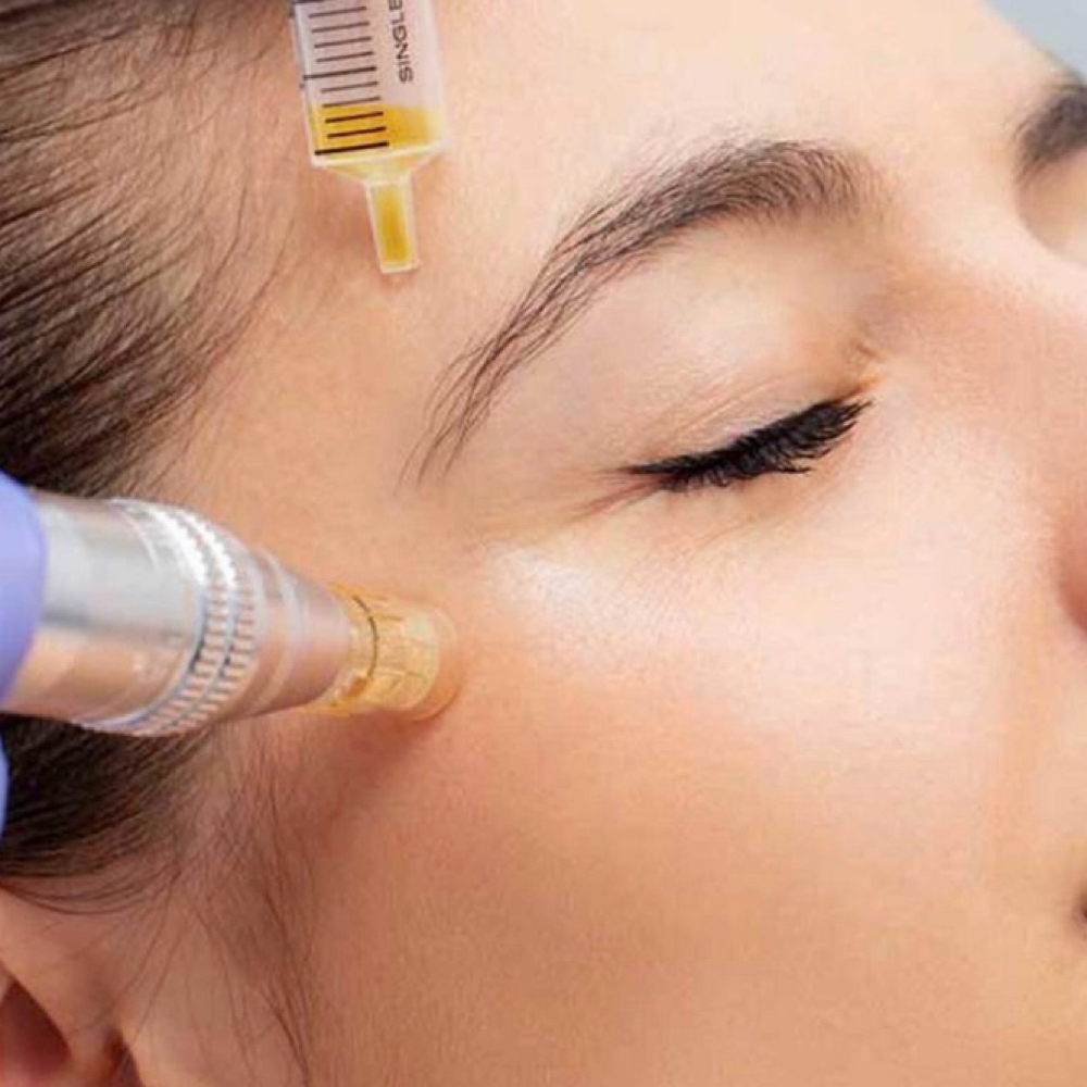 PRP Facial Rejuvenation at Med Esthetic in Edinburg, TX