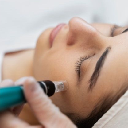 Micro-Needling Renewal Treatment at Shell Esthetics in Wilmington, NC