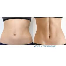 EMS Body Sculpting 3 Sessions at Couture Aesthetics in Weatherford, TX