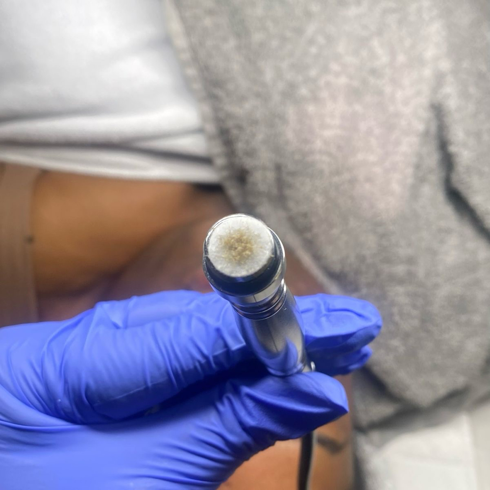 Microdermbrasion Facial