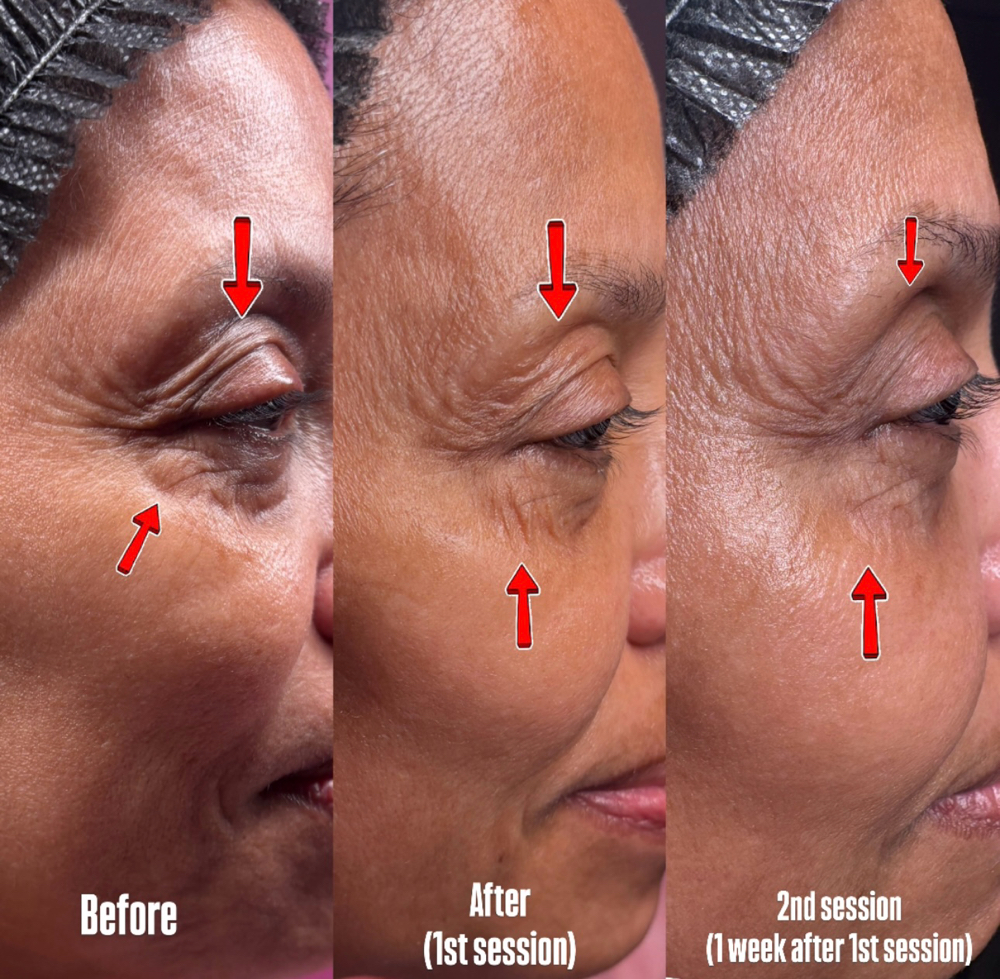 RF Skin Tightening & Contouring