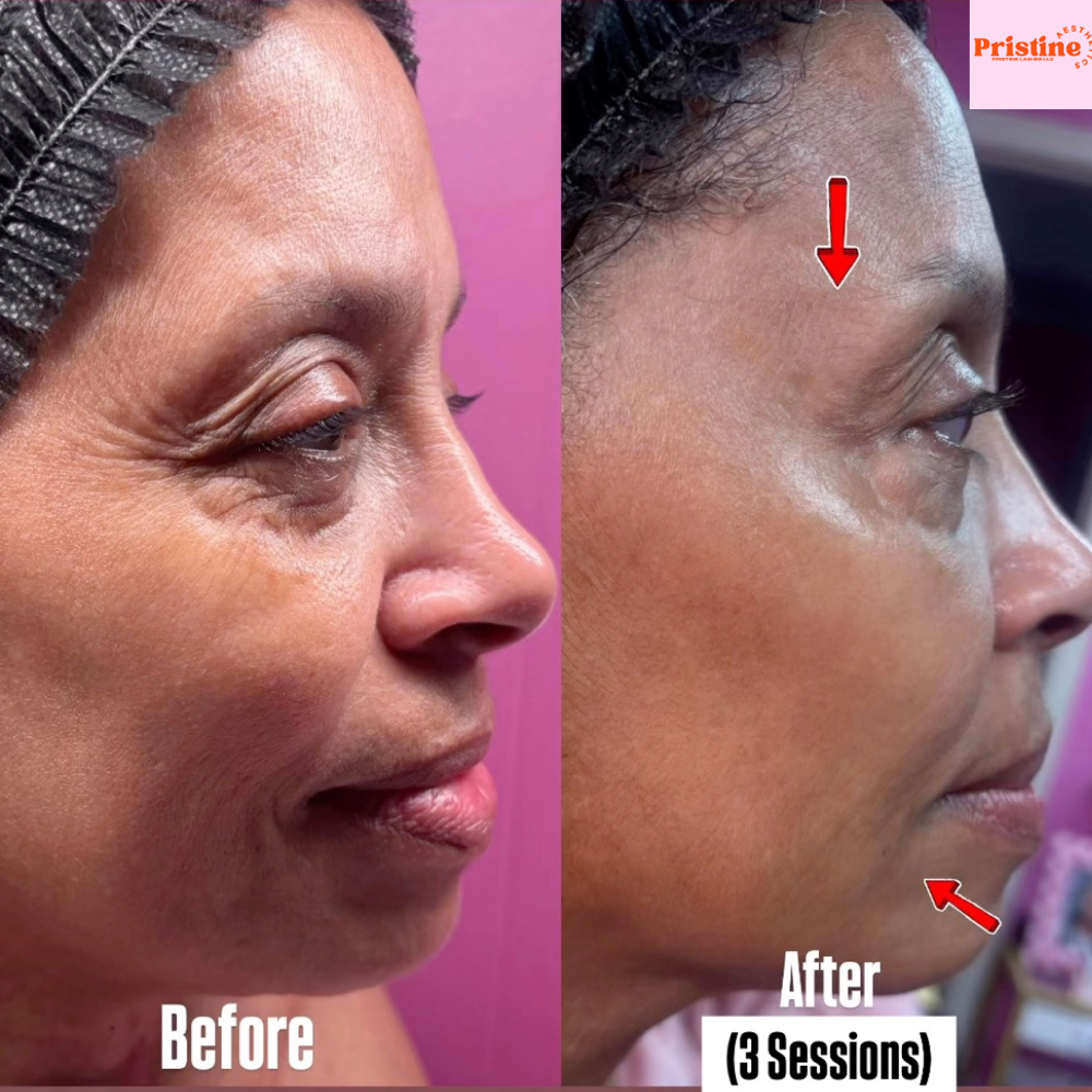 RF Skin Tightening & Contouring Pkg