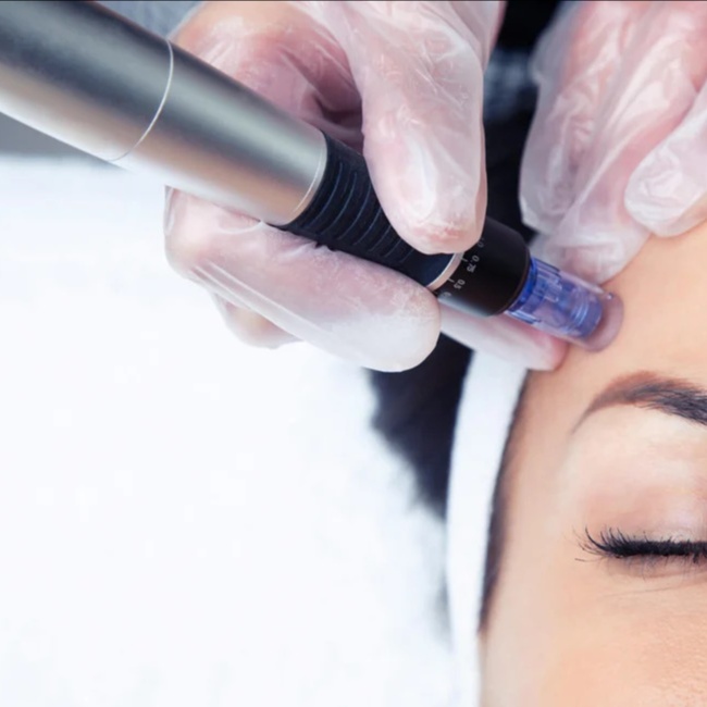 3 Face MicroNeedling Sessions at Skin Boutique North Carolina in Mooresville, NC