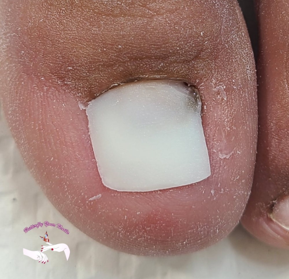 Toe Nail Reconstruction