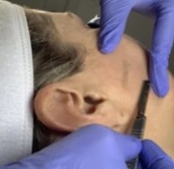 Dermaplane