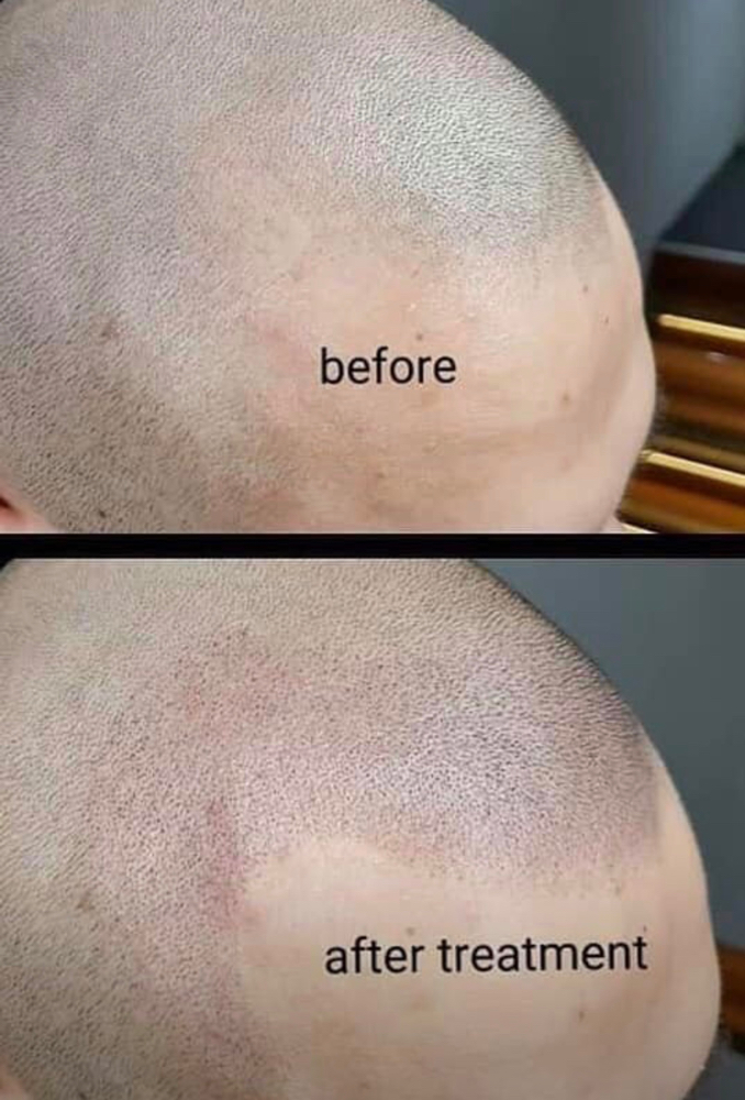 Scalp Micropigmentation Full Head