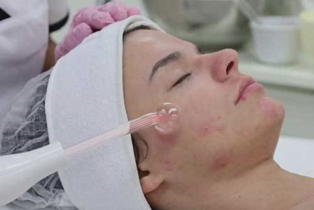 Acne Facial