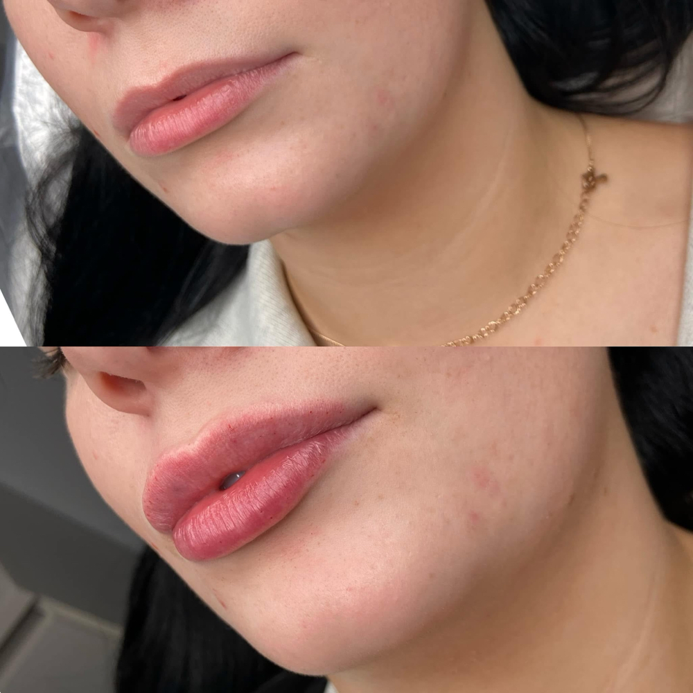 Half Syringe, Dermal Lip Filler💉 at AJ Rey Injects in Wolfforth, TX