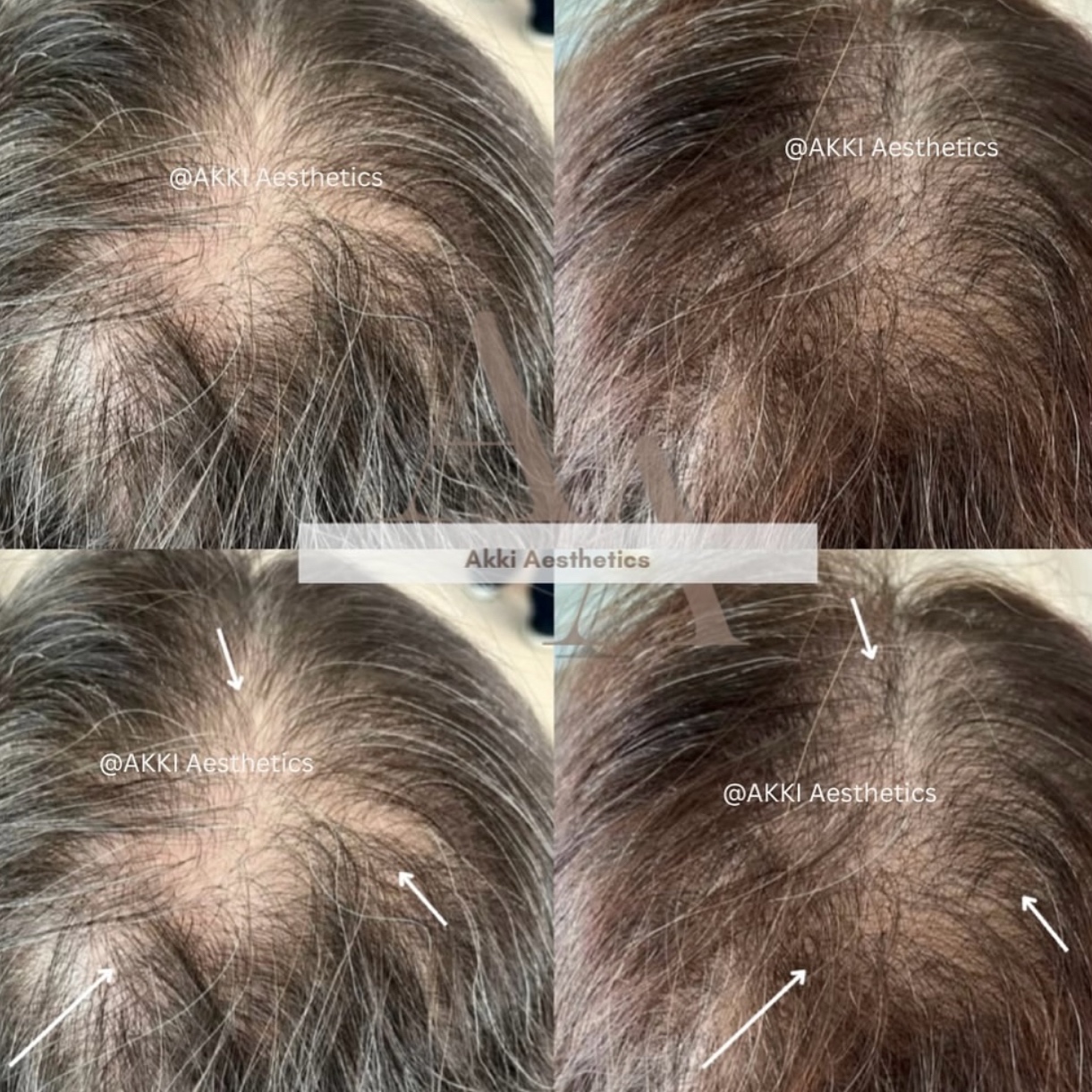 PRP Hair Growth at Akki Aesthetics in Williston Park, NY