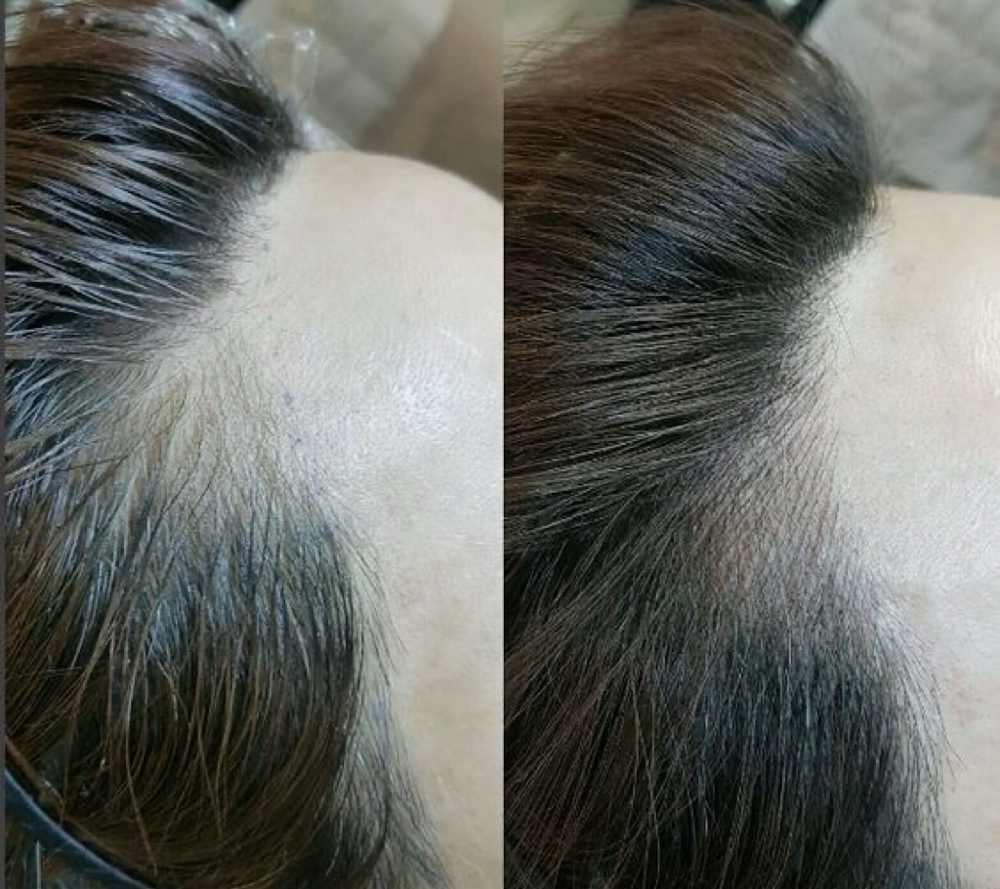 🎀SMP ( Hairline)
