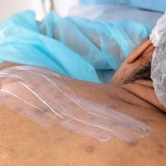 Clarifying Back Treatment at Esthetique, Darling LLC in Indianapolis, IN