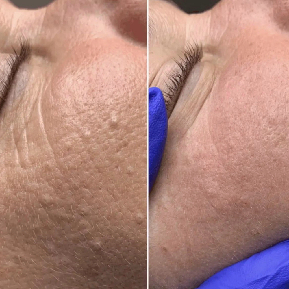 Skin Classic Thermolysis Treatment at Beyond Beauty & Glow in Lincolnshire, IL