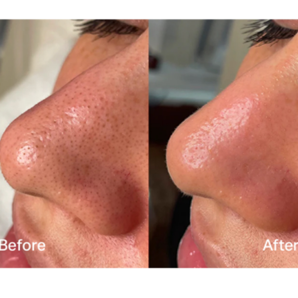 Deluxe HydraFacial at Cura Viso Aesthetics in West Chester, PA