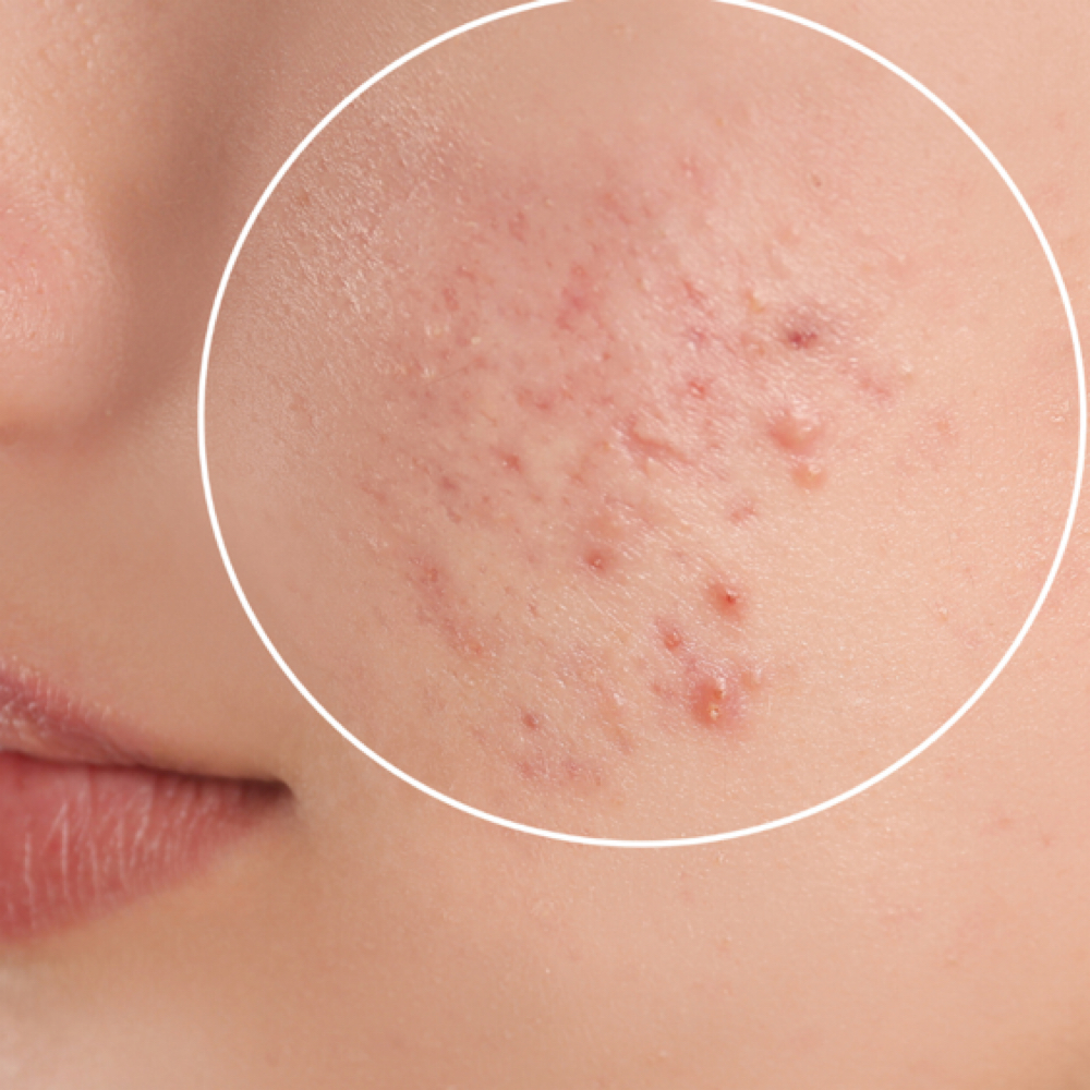 The Breakout Recovery Facial at Bare Beauty Esthetics in Pilot Mountain, NC