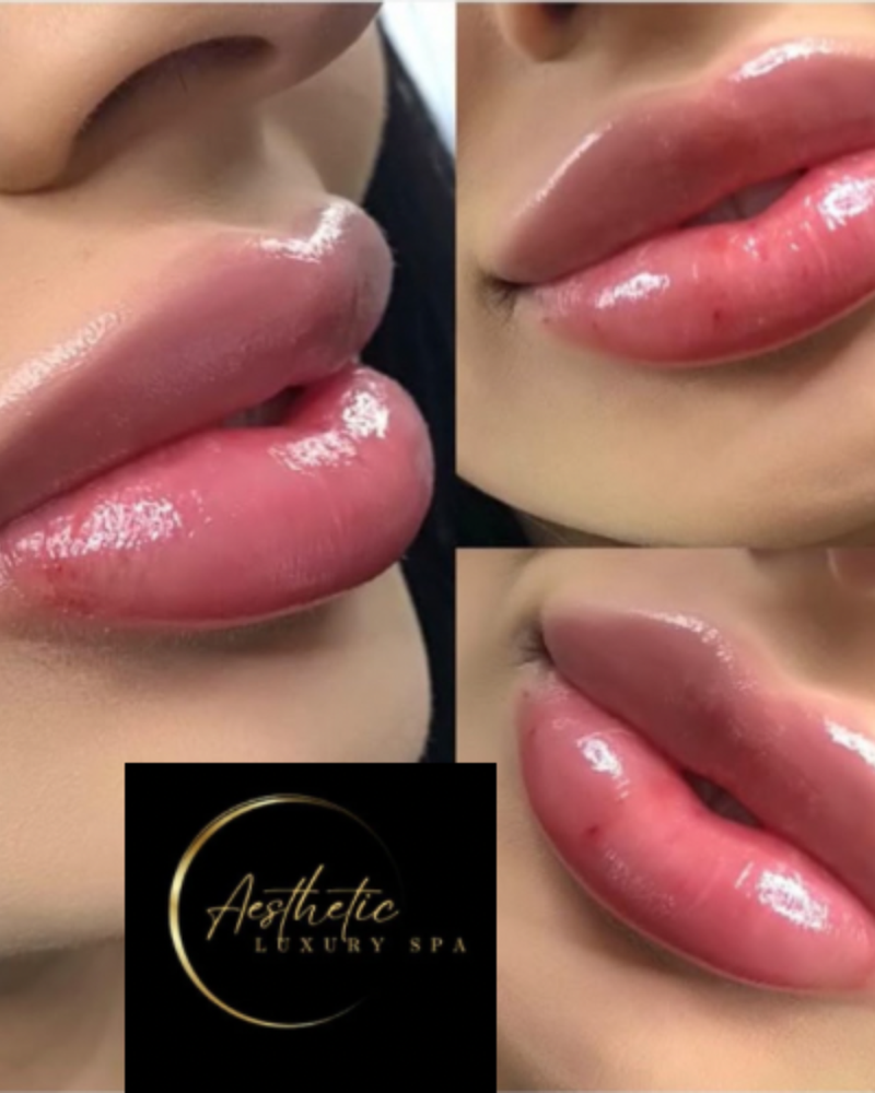 (1.5 ML) Lip Filler Touch-up