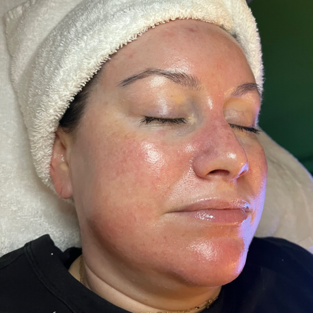 Deluxe Hydrafacial™️ at Genesis Health and Beauty Bar in Daphne, AL