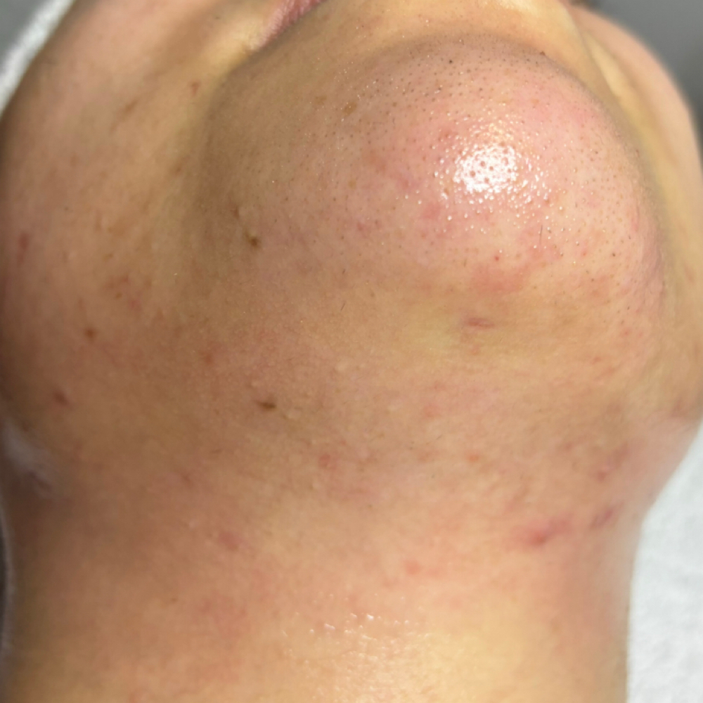 Chin Wax at Pearly Derm in Sun valley, CA