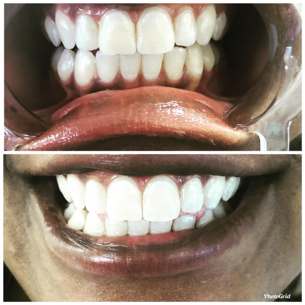 Basic Teeth Whitening at Shaqs Teeth Whitening in Tarboro, NC