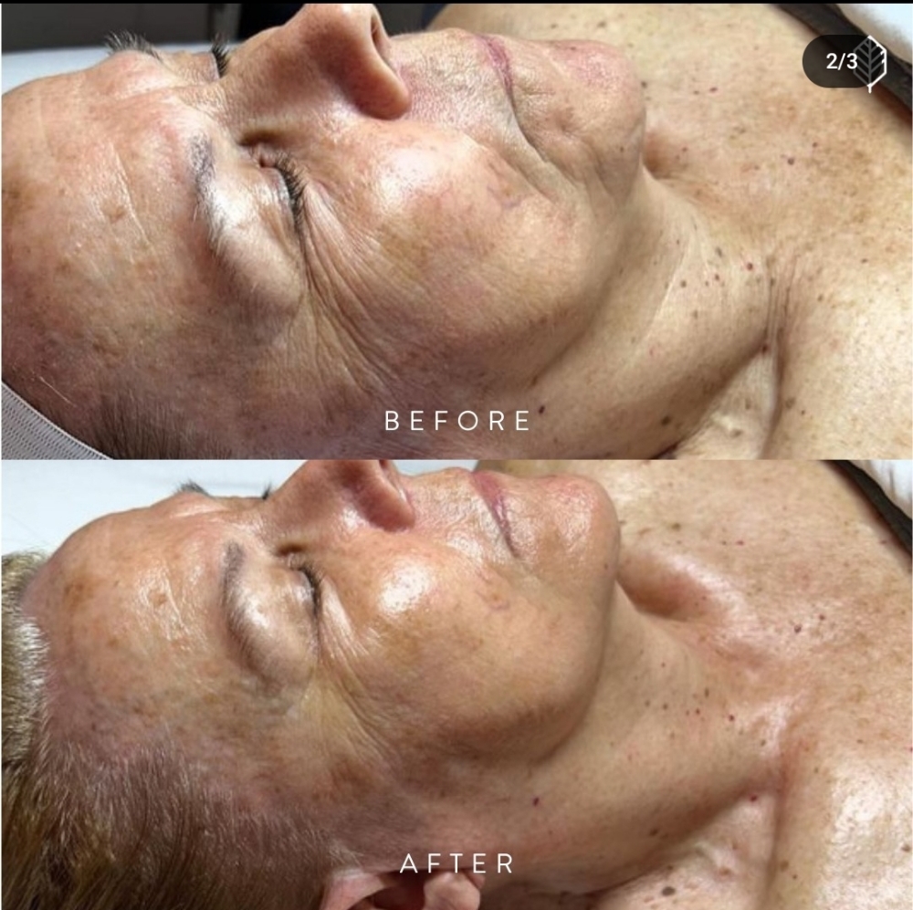 Age Defiance Facial