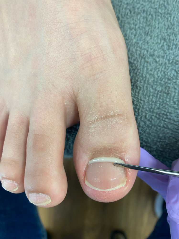 Onyfix (Hard) Band  Repair