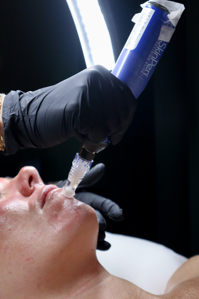 SCAR REPAIR (SkinPen MicroNeedling)
