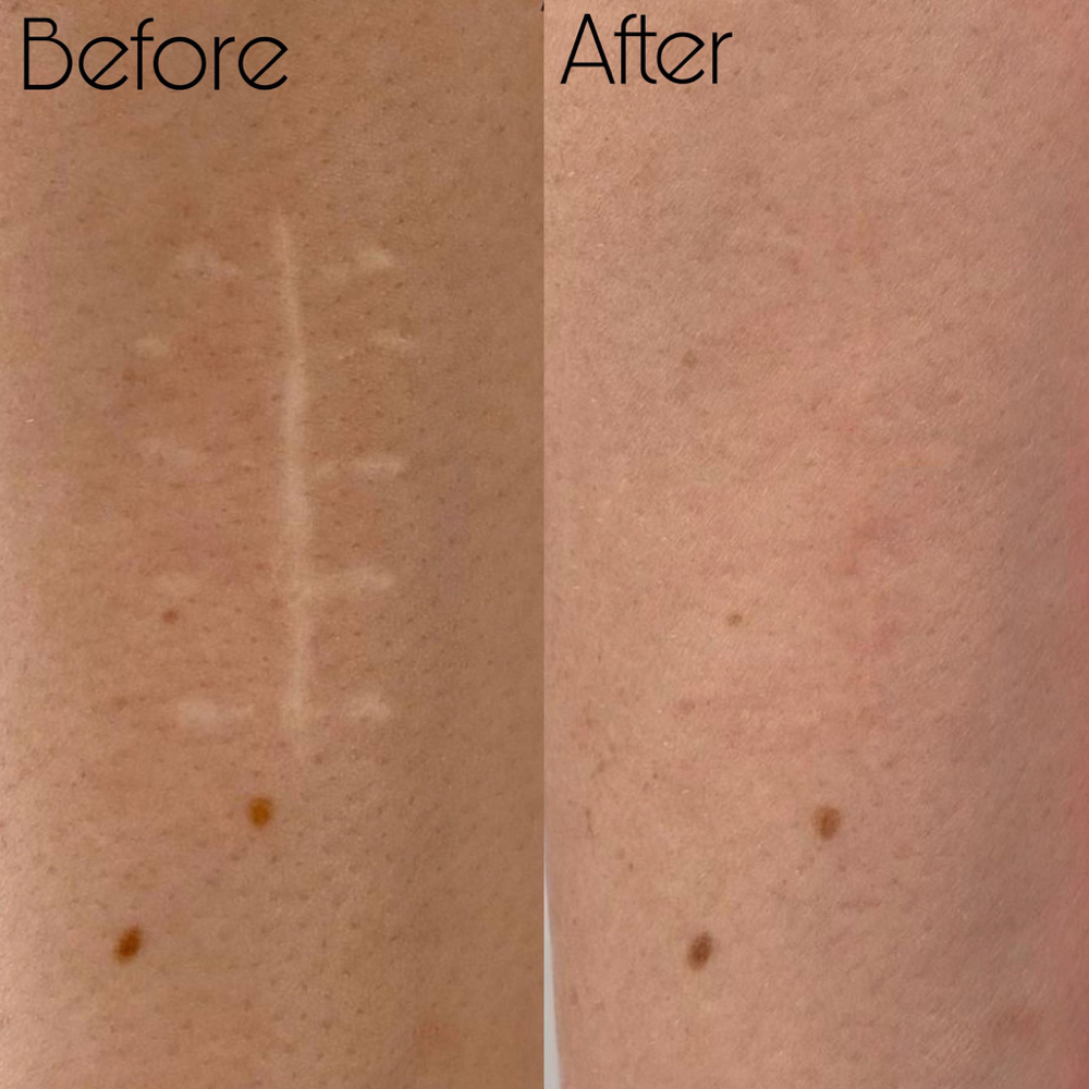 Consultation For Scar Camouflaging