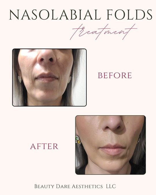 1ml Filler To Nasolabial Folds