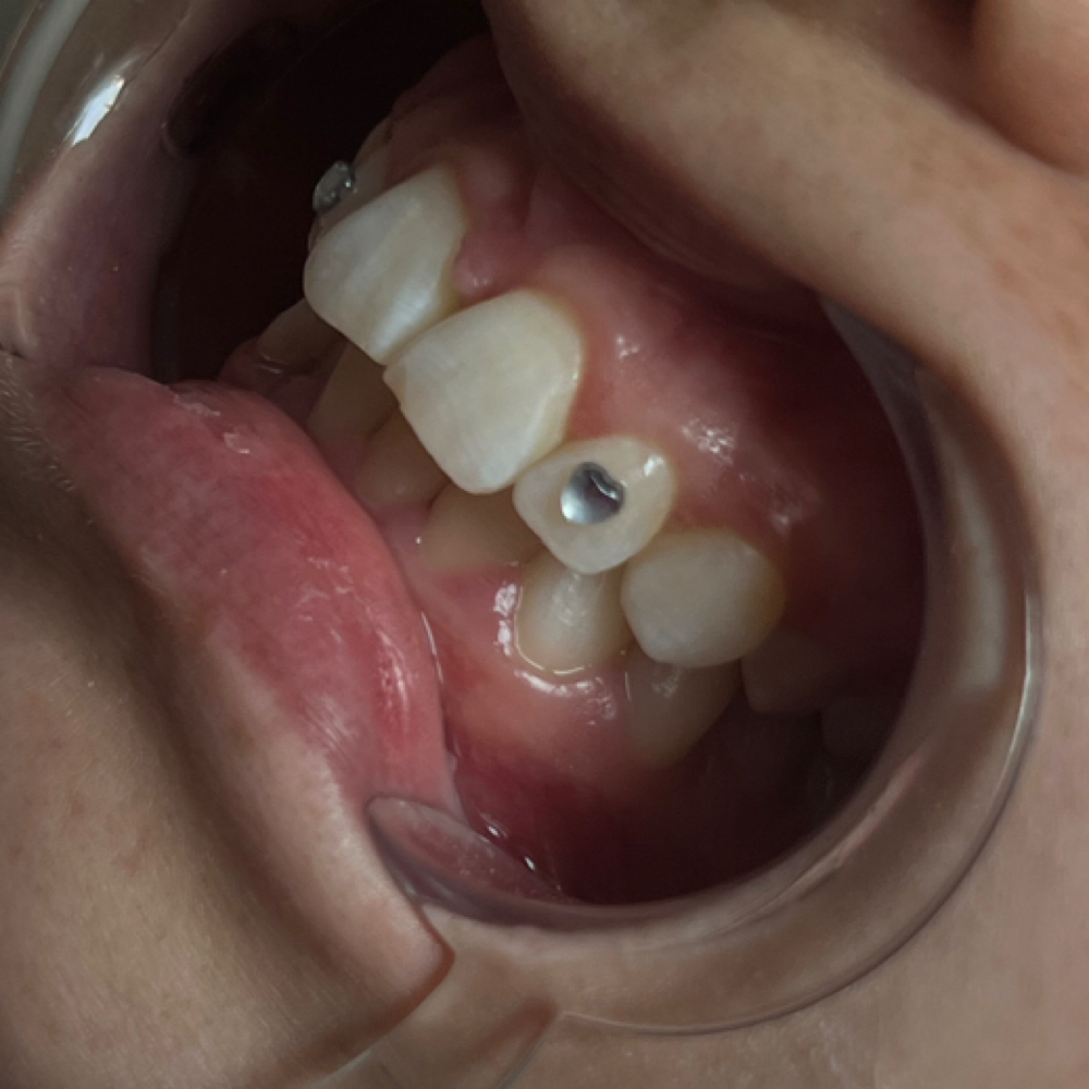 Individual Single Tooth Gem at SayitwithKolour in indianapolis, IN