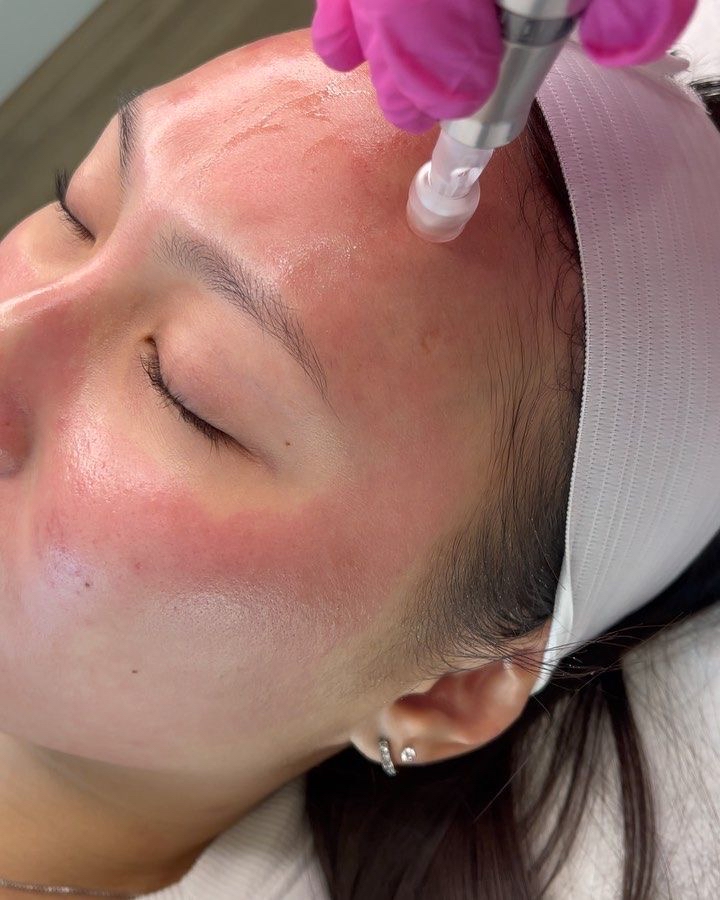 Microneedling Facial