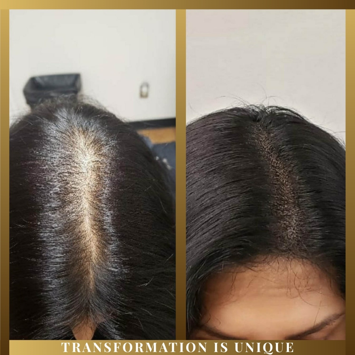 SMP Women’s Edge/Crown Restoration