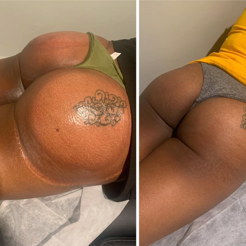 Peach Lift Package of 3 at CurvSculpt in Denver, CO