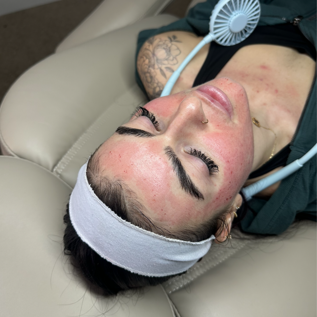 Microneedling at artelē aesthetic collective in Fairlawn, OH