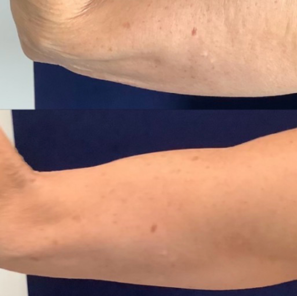 Bat Wings at Silhouette Body Sculpting LLC in St. Peter’s, MO