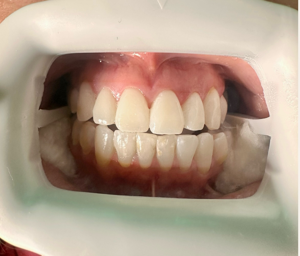Teeth Whitening On The Go Kit