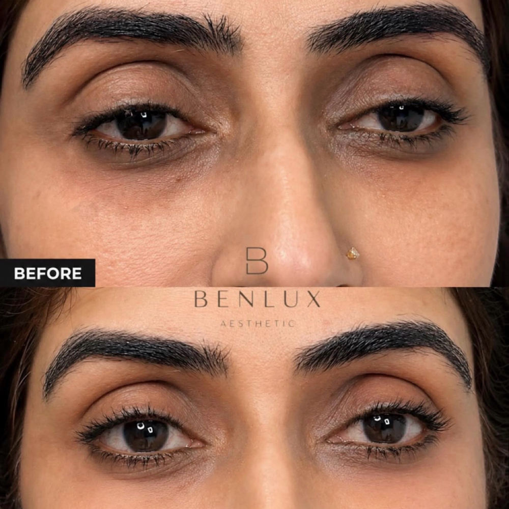 Liquid Blepharoplasty at Benlux Aesthetics in Annandale, VA