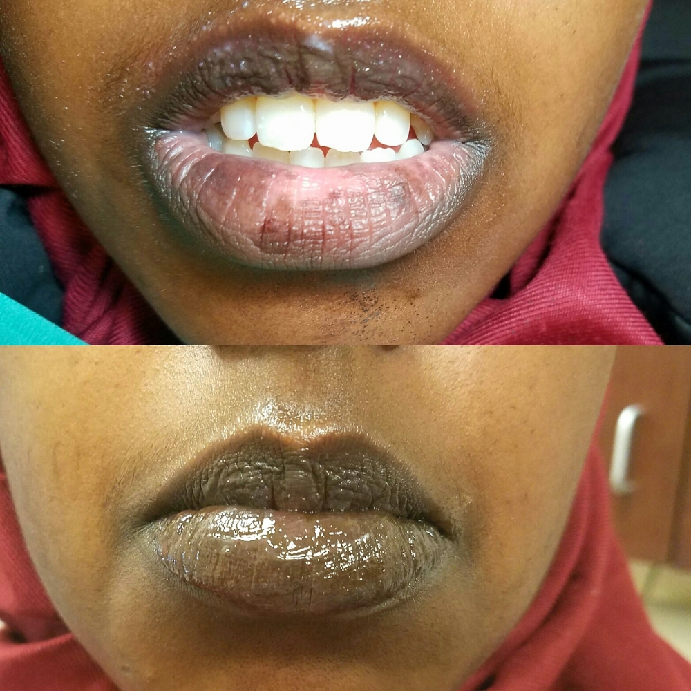 Lip Neutralization