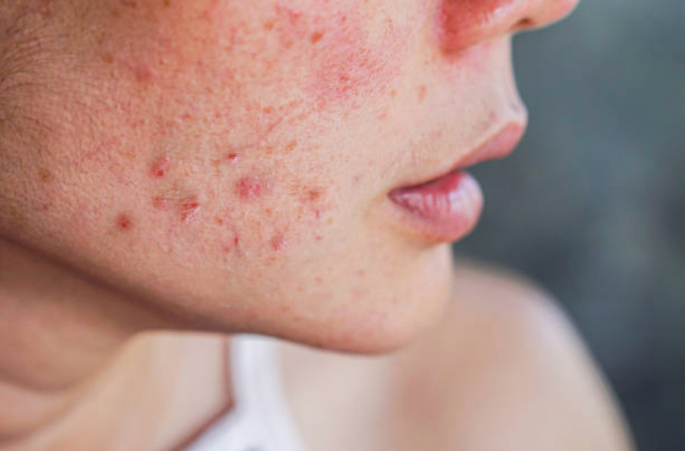 Acne Facial Treatment
