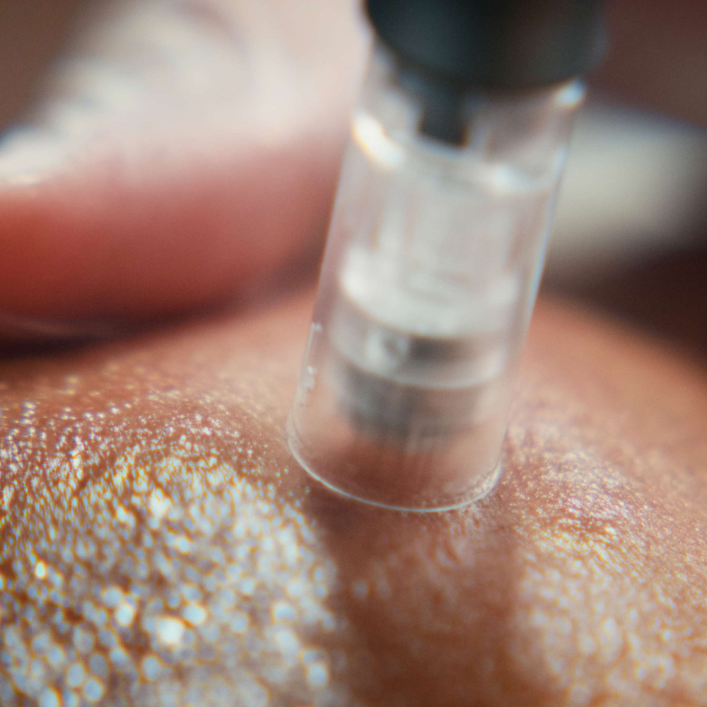 MicroNeedling
