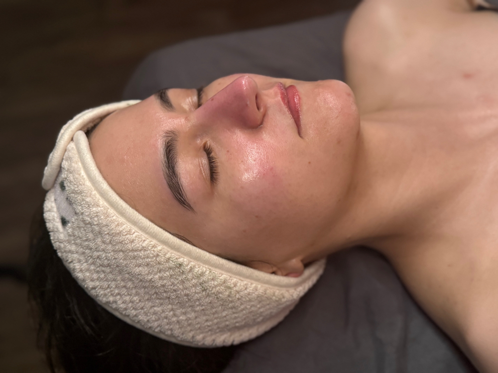 Chemical Peel