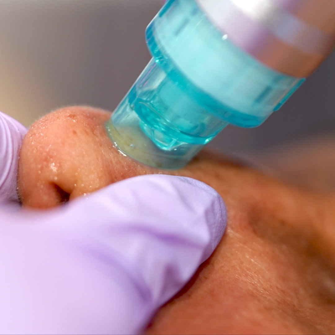 Hydrodermabrassion Facial at Radiant Glow Skin Spa in Beaumont, TX