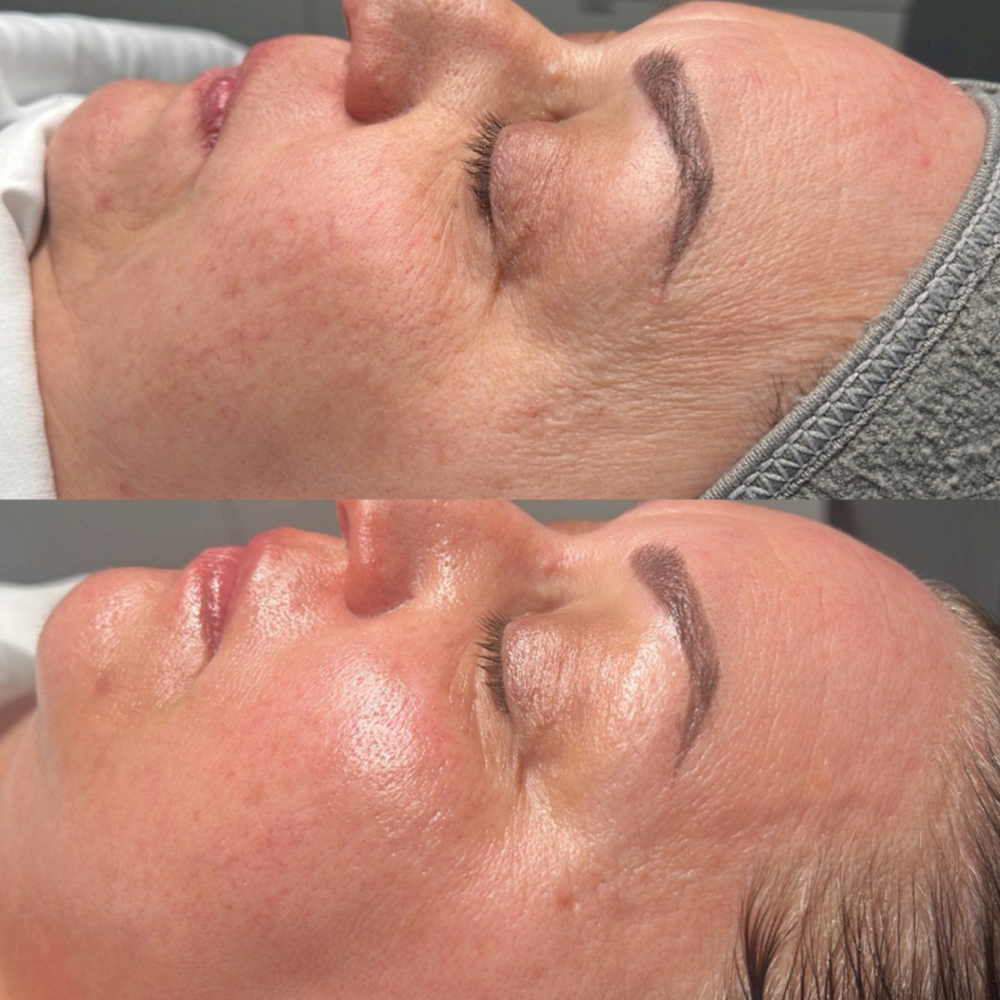 Chemical Peel