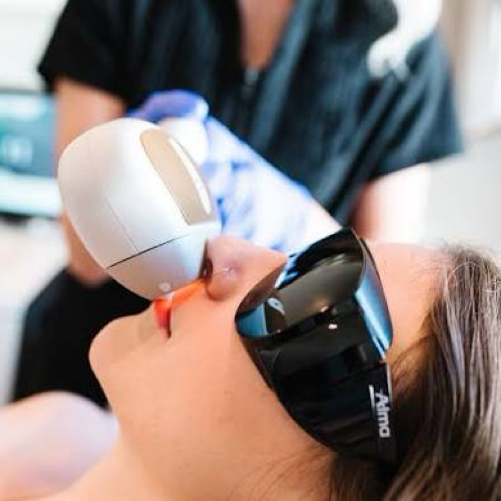 Laser Hair Removal (Upper Lip)