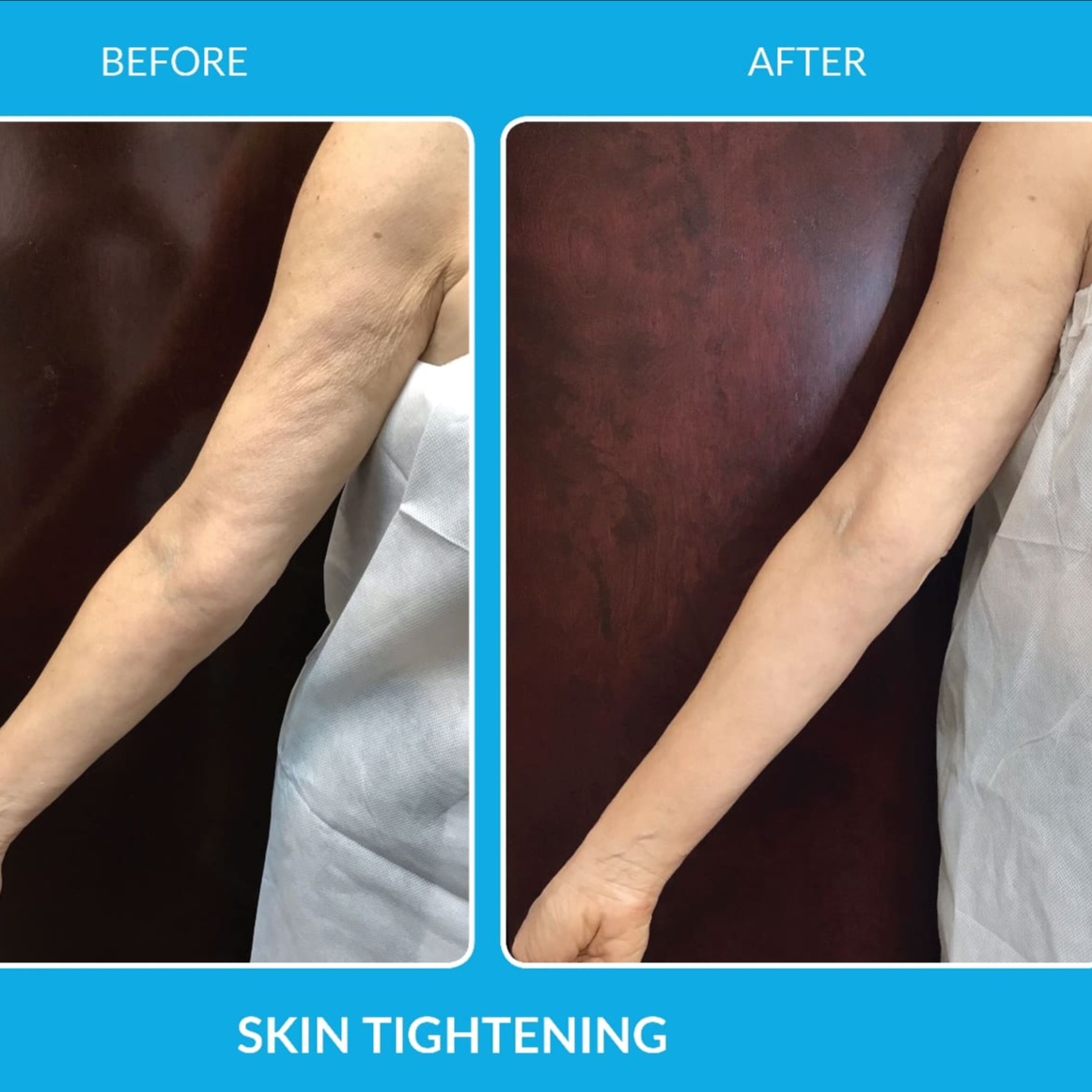 Skin Tightenning Body at GlowSkin by Gaby in Bonita Springs, FL