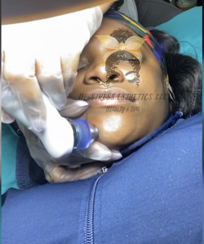 Microdermabrasion at De-Stress Esthetics LLC in Saint Louis, MO