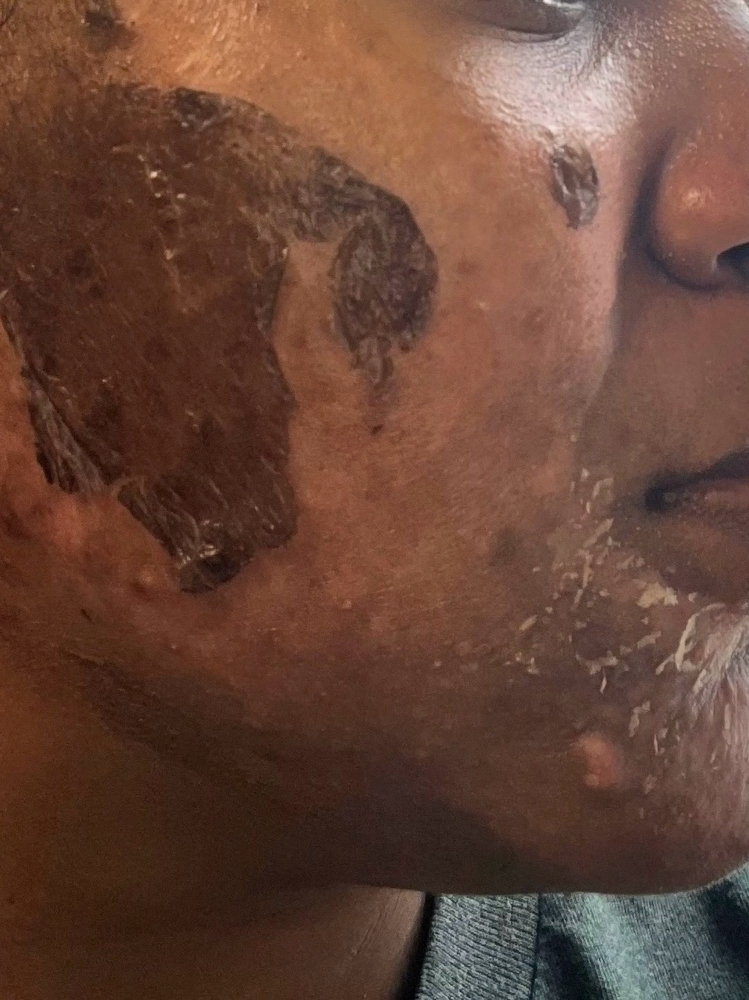 Corrective Facial: 3rd Phase