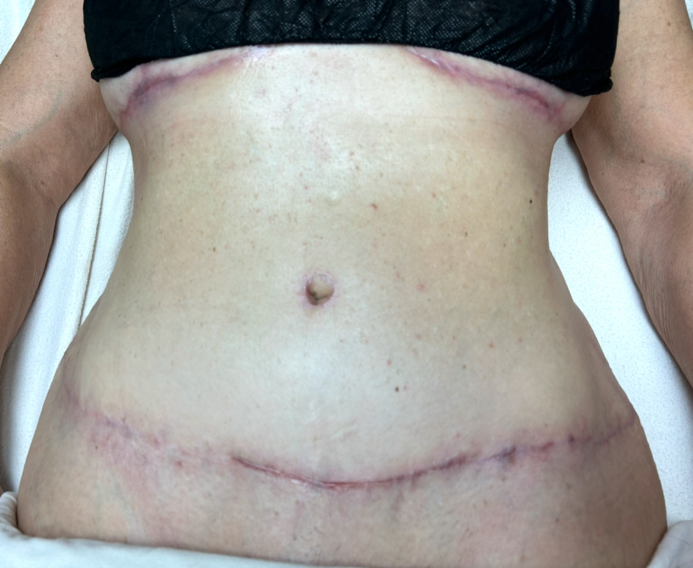 Tummy Tuck Lymph/PostOp Massage