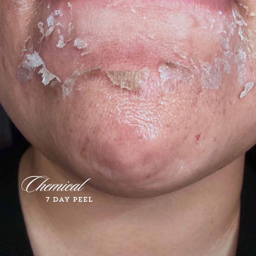 7- Day Chemical Peel & Aftercare at Ethereal Glow | Ayurveda Therapies in Fresno, CA